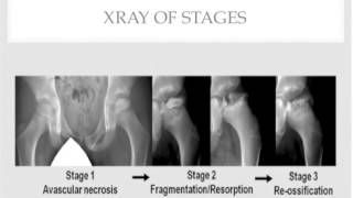 Legg Calve Perthes Disease [upl. by Fein993]