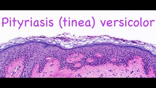 Pityriasis tinea versicolor [upl. by Gilbertson]