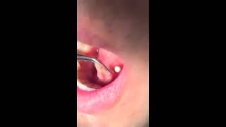 Sialolith removal from submandibular duct [upl. by Yeslek]