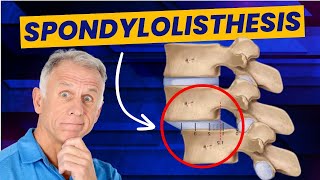 Spondylolisthesis 4 Exercises to Reduce Pain Demo on Real Patient [upl. by Nodle]