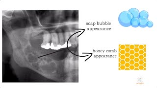 Ameloblastoma part 1 [upl. by Doretta]