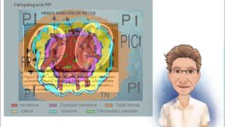 HEMORRAGIA INTRACEREBRAL FISIOPATOLOGÍA [upl. by Eugenio]