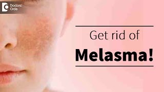 Melasma or pigmentation of skin Treatment available  Dr Deepak P Devakar [upl. by Hegarty]