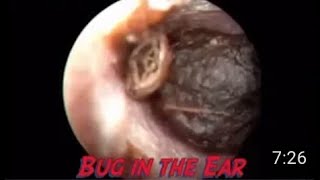 Insect inside the ear [upl. by Jaworski]