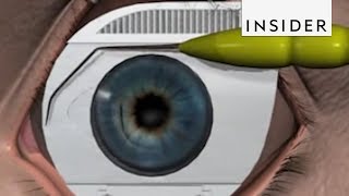 How LASIK Eye Surgery Is Performed [upl. by Aeslehc]