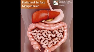 All About Peritoneal Tumours Causes Symptoms Diagnosis and Treatment [upl. by Jilleen]