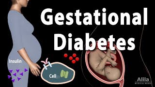 Gestational Diabetes Animation [upl. by Attenehs943]