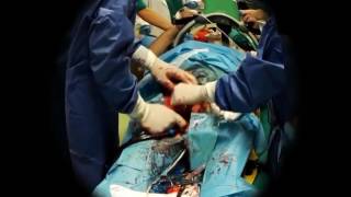 ECPR Extracorporeal CardioPulmonary Resuscitation [upl. by Relyhcs566]