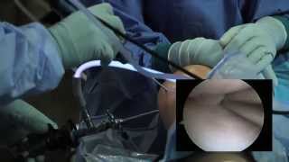 Arthroscopic Knee Surgery Meniscus Tear [upl. by Leisam]