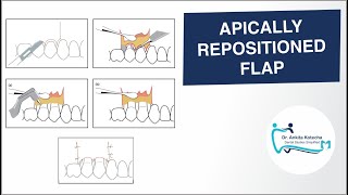 APICALLY REPOSITIONED FLAP PERIODONTAL FLAP SURGICAL TECHNIQUE DR ANKITA KOTECHA [upl. by Annat]