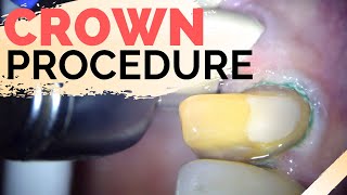 Dental Crown Explained  Anterior Crown Preparation [upl. by Alokin813]