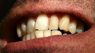 How to Straighten Crooked Teeth  Tooth Care [upl. by Behnken]