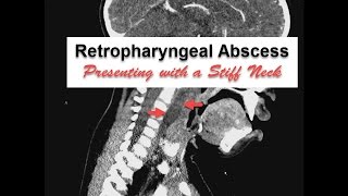 Neck Stiffness with Retropharyngeal Abscess [upl. by Celesta]