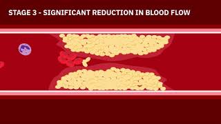 How COVID19 Affects Your Heart [upl. by Nad751]