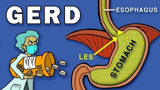 Gastroesophageal Reflux Disease GERD [upl. by Zertnom]