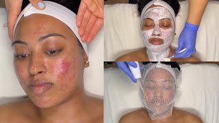 CYSTIC ACNE TREATMENT  WALKIN FACIAL FOR GRADE 3 AND 4 ACNE WITH PRO TIPS  LICENSED ESTHETICIAN [upl. by Eeclehc260]