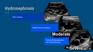 Hydronephrosis Ultrasound [upl. by Anaihr934]