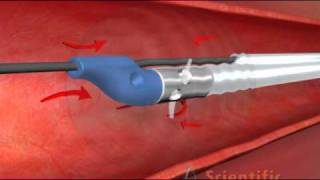 Treatment of DVT and PE [upl. by Adlih]