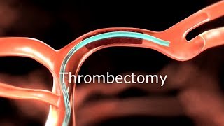 Thrombectomy Animation [upl. by Adahs]