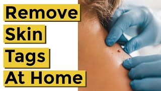 How to Quickly and Easily Remove Skin Tags at Home Using Things You Already Own [upl. by Odelinda]