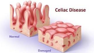 Celiac Disease [upl. by Lumbard]