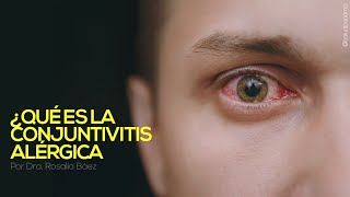 Conjuntivitis Alérgica síntomas y tratamiento [upl. by Elleon444]