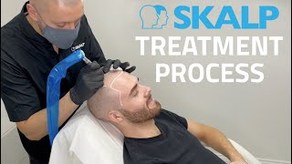 Skalp® Scalp Micropigmentation Treatment Process [upl. by Alial86]