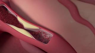 Cardiomyopathy Overview Restrictive Dilated Hypertrophic pathophysiology symptoms [upl. by Julia275]