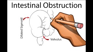 Intestinal Obstruction  Part 1 [upl. by Mlehliw]