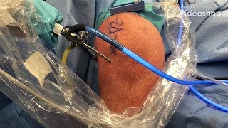 Do I Need A Knee Scope Knee Arthroscopy [upl. by Ut]