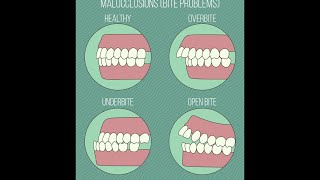 Different Types of Malocclusions [upl. by Ainivad]