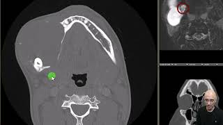 Ameloblastoma [upl. by Senecal]