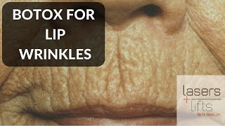 BOTOX for lip wrinkles [upl. by Tnilc]