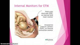 Electronic Fetal Monitoring [upl. by Enela754]