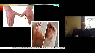 Peripheral Neuropathy and Mononeuropathy [upl. by Florri446]