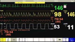 Cardiac Arrest  Patient Monitor [upl. by Yenar]