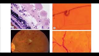 Kanski Clinical Ophthalmology Made Easy  Retina 2 [upl. by Halstead]