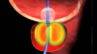 Cooled ThermoTherapy Procedure Animation [upl. by Aliakam239]