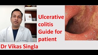 Ulcerative colitis Treatment and Symptoms अल्सरेटिव कोलाइटिस In Hindi Dr Vikas Singla [upl. by Uthrop]