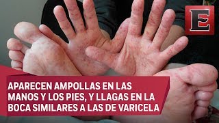 Transmisión sintomas y cuidados del virus de Coxsackie [upl. by Alejandro]