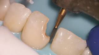 Teeth Bonding  Front tooth filling EXPLAINED [upl. by Lora700]