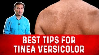 Best Tips for Tinea Versicolor Treatment Skin Fungus – Dr Berg [upl. by Chrissy14]