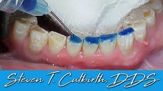 Bonding Worn Anterior Teeth  Dental Minute with Dr Steven T Cutbirth DDS [upl. by Maurer488]