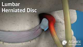 Lumbar Herniated Disc Overview [upl. by Storz]