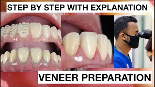 Step by Step Minimally Invasive Veneers Preparation  General Dentist Griya RR [upl. by Cralg]