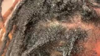 How to remove scalesdandruff or seborrheic dermatitis from the scalp [upl. by Aitital]