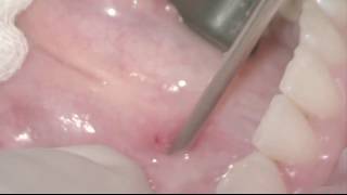 Submandibular Salivary Gland Sialendoscopy for Sialolithiasis [upl. by Leinehtan888]