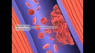 Formation of Deep Vein Thrombosis [upl. by Adnolay]