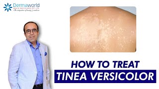 Tinea versicolor  Dr Rohit Batra  Tinea Versicolor Treatment  How to treat Tinea Versicolor [upl. by Atibat200]