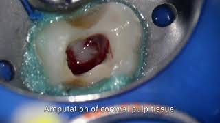 MTA pulpotomy – Video abstract ID 134315 [upl. by Benjamin200]